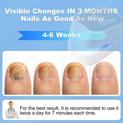 Nail Fungus Treatment Device